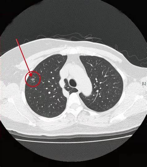 肺部磨玻璃影怎样造成