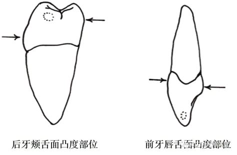 牙齿嵌体和牙冠哪个好?看看牙齿嵌体和牙冠的优缺点_之美网