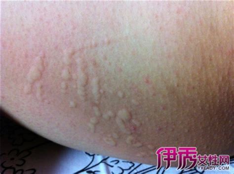 风团疹图片