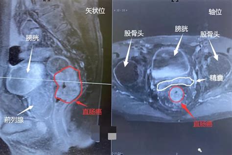 结直肠癌无创筛查技术：粪便SDC2甲基化检测-武汉市江夏区第一人民医院