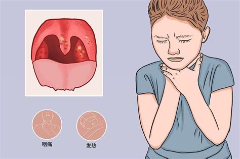温馨提醒 | 预防疱疹性咽峡炎传染病_深圳新闻网