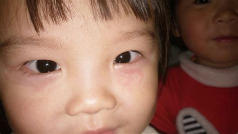宝宝眼睛不知道为什么红了 像过敏一样？有宝宝有一样的情况吗？怎么办 - 百度宝宝知道