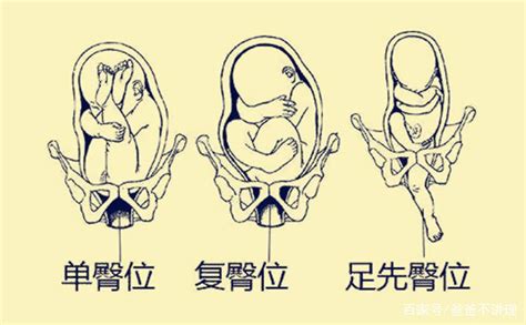胎儿什么时候“开始入盆”？臀位也能入盆？孕妇应注意哪些问题？