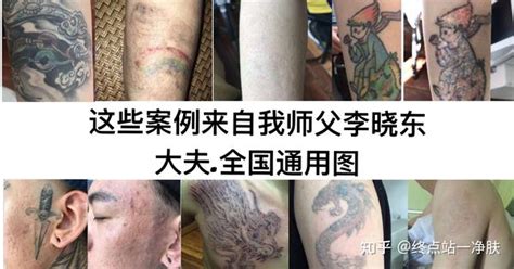 上海哪家正规医院洗纹身好的，价格多少左右？-