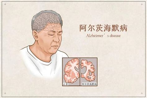 中国学者发文确认 发现19岁男孩患阿尔兹海默症，不记得是否吃过饭_凤凰网视频_凤凰网