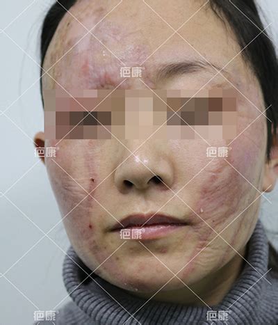 山东铁女士硫酸烧伤瘢痕增生治疗案例 - 北京疤康