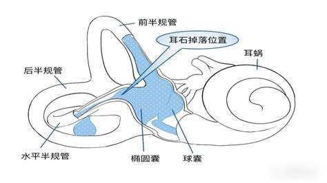 耳石症图片