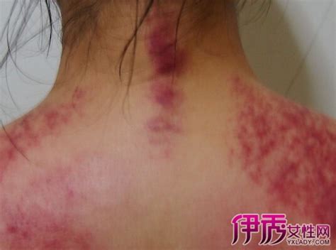 背部刮痧示意图图片