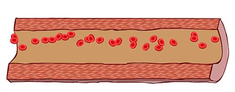 4个信号说明你的血液太粘稠了！化血栓、防心梗吃它最管用 _ 药最网 - www.yaozui.com