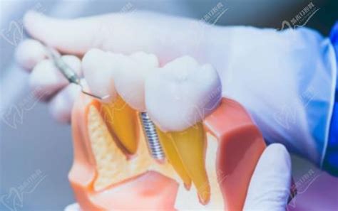 太原哪里看牙比较好？要找拔牙/种牙价格优惠的牙科医院,种植牙-8682赴韩整形网