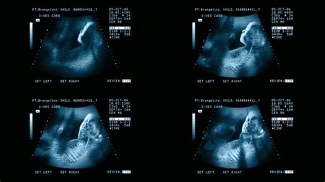 详解双胞胎卵黄囊出现时间，超过孕8周仍不可见一定不正常_家庭医生在线