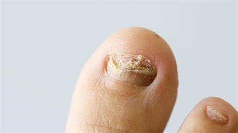 常见甲部疾病，白甲症和灰指甲有这些区别|疾病|白斑|抗真菌_新浪新闻