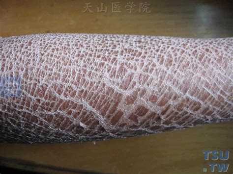 鱼鳞病（ichthyosis）症状表现 - 皮肤病学 - 天山医学院