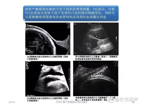 瘢痕子宫图片