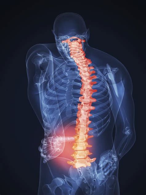 腰椎间盘突出症和马尾神经综合征有哪些关系？ - 知乎