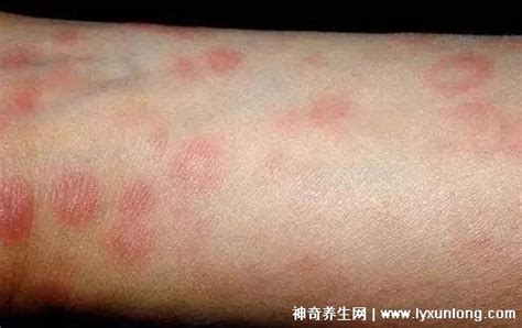 初期梅毒疹图片症状，躯干上的斑疹/皮疹/脓疮蔓延至手脚心 — 神奇养生网