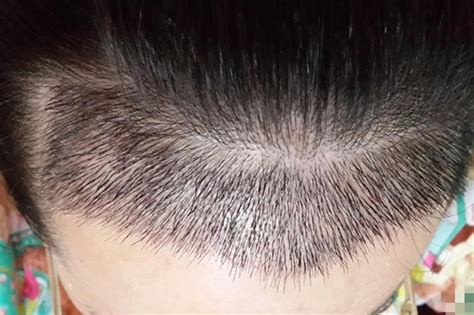 种植头发能保持几年?植发多久能看到果?_千颜网
