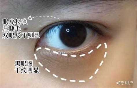 黑眼圈重怎么办，不同的黑眼圈有不同得解决办法！_凤凰网健康_凤凰网