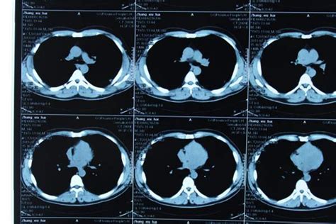 肺部炎症的“七大”常见CT表现 - 影像核医学 -丁香园论坛