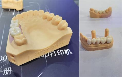 牙齿矫正背后的智能制造，齿科3D打印解决方案|飞凌智慧医疗解决方案 - 飞凌嵌入式行业资讯 - 保定飞凌嵌入式技术有限公司