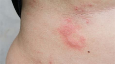 湿疹能不能自愈 治疗湿疹多久可以好-湿疹治愈率-复禾健康