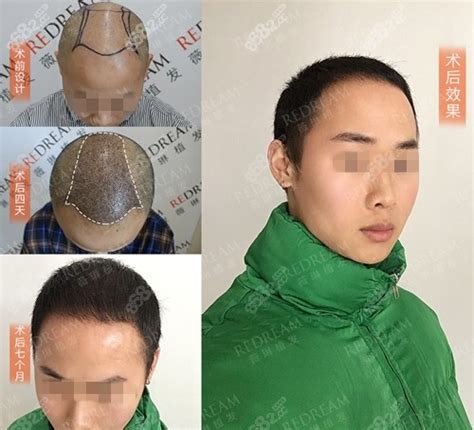 案例图证实在韩国出名植发医院毛杰琳做头顶加密效果不错 - 爱美容研社