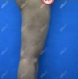 大腿吸脂凹陷修复成功，分享我在深圳仁安雅做手术的照片-8682赴韩整形网
