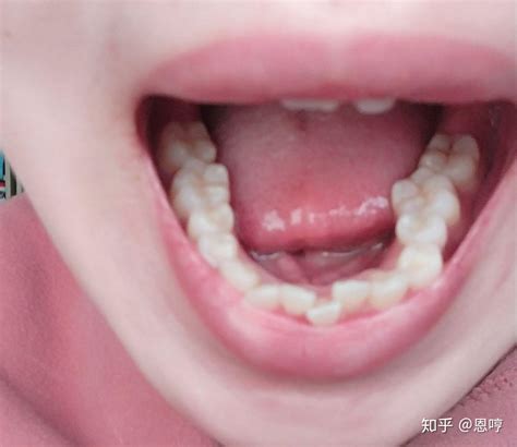 三例上颌磨牙颊侧倾斜引起正锁颌的矫治策略-正畸刘洪杰的博客-KQ88口腔博客