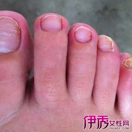 灰指甲对人体的危害有哪些 灰指甲常见的5大危害-灰指甲概况-复禾健康
