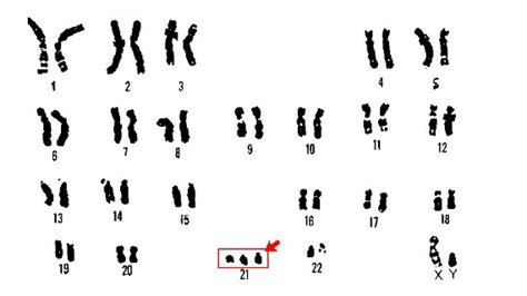 染色体异常能生育吗？ - 知乎