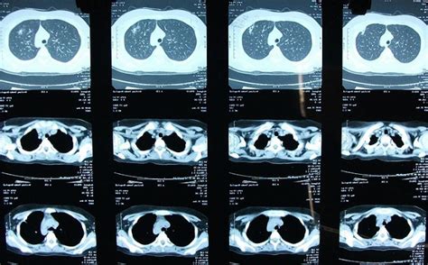 肺部CT图像中的解剖结构分割方法综述