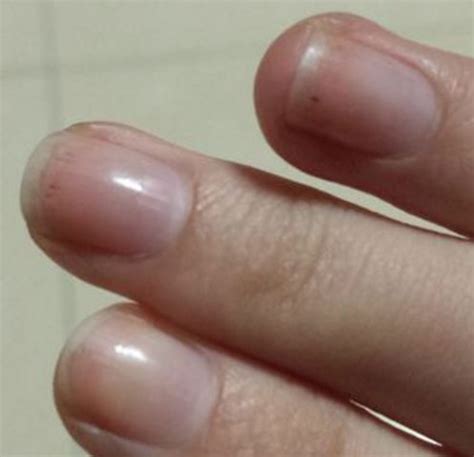 灰指甲初期症状有哪些呢？ - 知乎