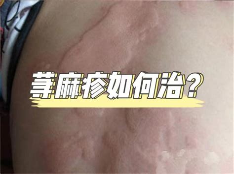 荨麻疹症状怎么治_荨麻疹_北京京城皮肤医院(北京医保定点机构)