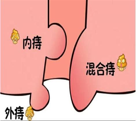 痔疮什么样的图片