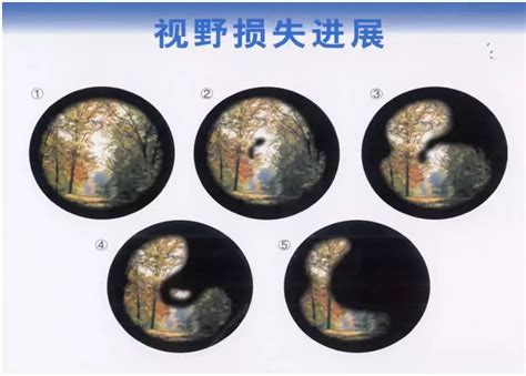 视野缺损自测图图片