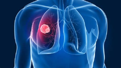 5类肺癌的影像学表现（多图）