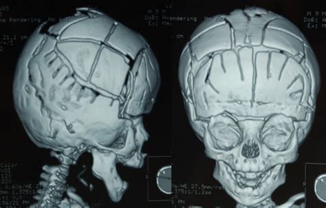 汇思想 _ 3D打印引导“人骨拼图”,狭颅症儿童成功矫型