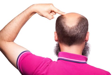 造成斑秃的成因是什么？斑秃可分为哪几类？|斑秃|毛发|脱发_新浪新闻