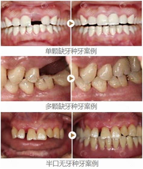 2021牙科收费标准新公布，含种植牙、牙齿矫正活动价格 - 爱美容研社