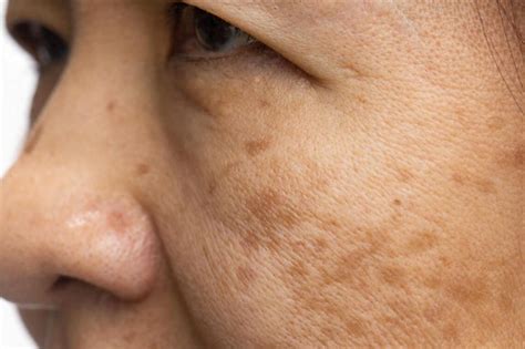 3. 老年性皮肤瘙痒症