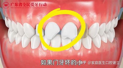 意外受伤导致牙齿连根脱出 还有没有救？_长沙市口腔医院_健康频道