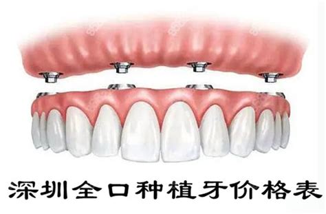 深圳全口种植牙价格表2022,补贴后满口种植牙费用5-10几万,种植牙-8682赴韩整形网