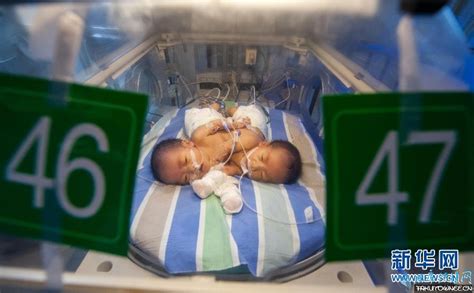 中国连体姐妹双胞胎，连体婴儿不分离能活多少岁？_法库传媒网