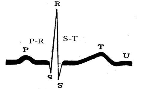 心电图图例分析：完全性左束支阻滞、双源性室性早搏 - 爱爱医医学网
