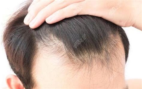 男性M型脱发发际线种植 - 微医（挂号网）
