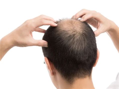 有望拯救秃头！新研究发现脱发关键原因：细胞失去黏性|干细胞|毛囊|秃头_新浪新闻