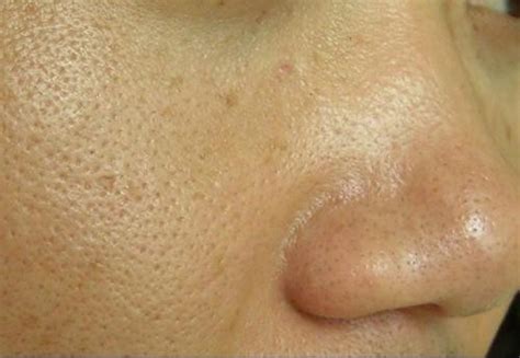 “毛孔粗大”怎么办？掌握这些技巧，有效改善皮肤毛孔粗大的问题|先天|毛孔|皮肤_新浪新闻