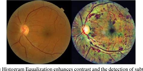 Figure 5 from Automated Detection of Diabetic Retinopathy using Deep ...