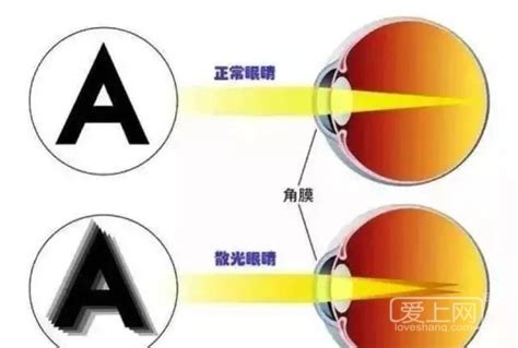 散光是怎么造成的散光怎么恢复（好好的眼睛为什么突发散光？还能治好吗） | 说明书网