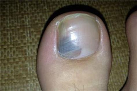 轻微灰指甲初期怎么治（灰指甲如何预防？如何治疗？医生：记住这几点，控好灰指甲） | 说明书网
